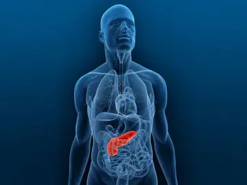 Cáncer de páncreas Cáncer de páncreas