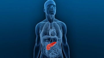 Cáncer de páncreas Cáncer de páncreas