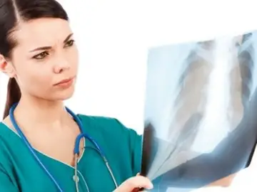 EL cáncer de pulmón EL cáncer de pulmón