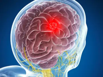 cáncer cerebral cáncer cerebral