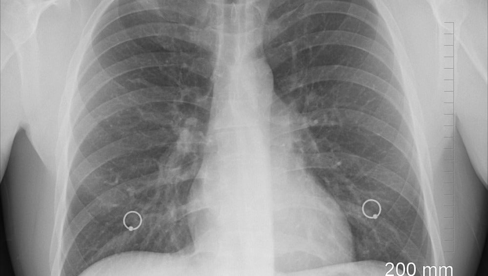 Científicos descubren una nueva solución que frena la metástasis en el pulmón