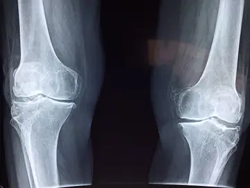 Cuidar de los huesos, a lo largo de nuestra vida, es fundamental para tener una mejor calidad de vida y prevenir la osteporosis. ¿Cómo podemos fortalecerlos? Consumir alimentos ricos en calcio o vitamina D son algunos ejemplos. Cuidar de los huesos, a lo largo de nuestra vida, es fundamental para tener una mejor calidad de vida y prevenir la osteporosis. ¿Cómo podemos fortalecerlos? Consumir alimentos ricos en calcio o vitamina D son algunos ejemplos.