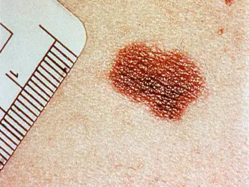 Melanoma Melanoma