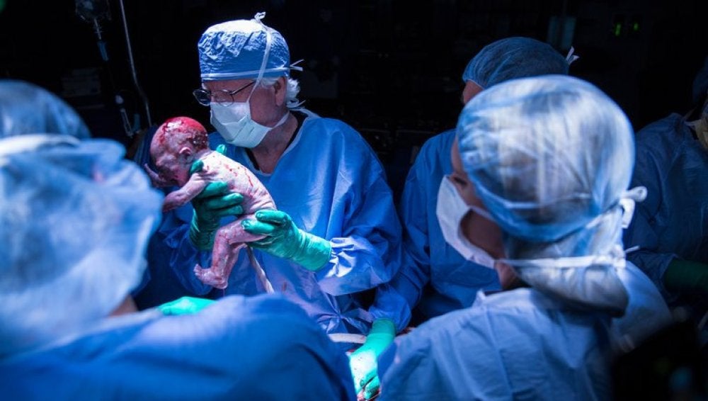 Bebé nacido de un útero trasplantado