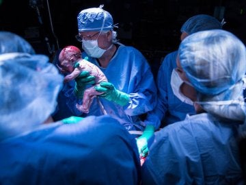 Bebé nacido de un útero trasplantado
