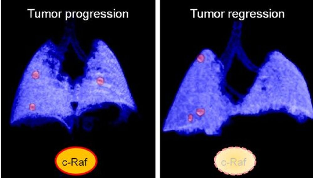 Una nueva estrategia induce la regresión de tumores de pulmón avanzados en ratones 