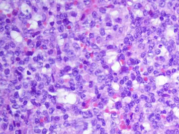 Descifran como funciona el genoma de la leucemia Descifran como funciona el genoma de la leucemia