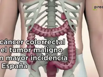 Metástasis y trombosis de tumores digestivos Metástasis y trombosis de tumores digestivos