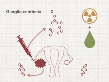 Estudio de la técnica del ganglio centinela para disminuir las secuelas de la cirugía en cáncer de ovario Estudio de la técnica del ganglio centinela para disminuir las secuelas de la cirugía en cáncer de ovario