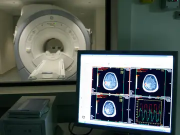 Imagen de un tumor cerebral Imagen de un tumor cerebral