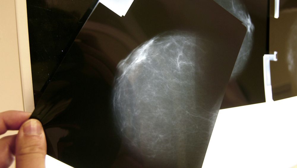 Vista de una radiografía de mama