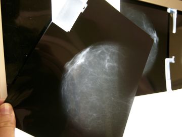 Vista de una radiografía de mama