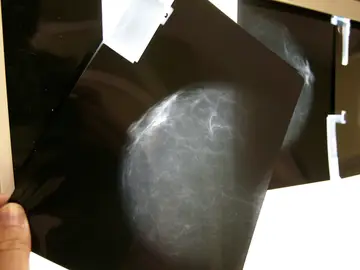 Vista de una radiografía de mama Vista de una radiografía de mama
