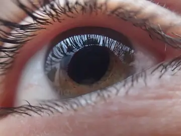 Ojo con glaucoma Ojo con glaucoma