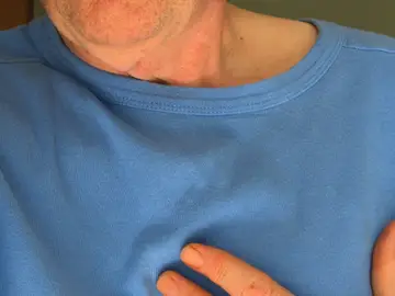 Infarto Infarto