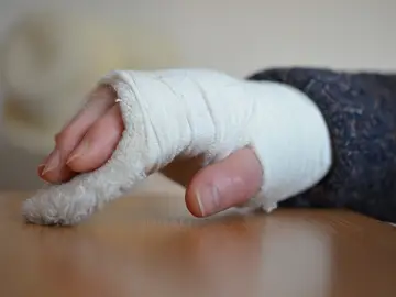 Mano con escayola Mano con escayola