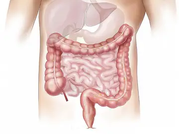 Cáncer de colon Cáncer de colon