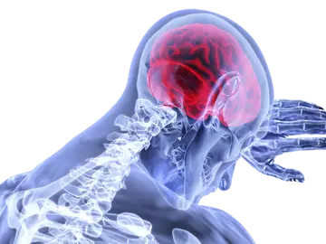 Ictus cerebral Ictus cerebral