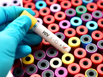 Análisis de sangre con resultado VIH positivo Análisis de sangre con resultado VIH positivo