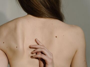 Es importante revisarse los lunares de la piel para prevenir el melanoma