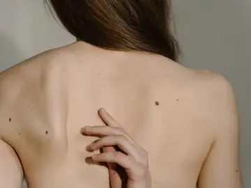 Es importante revisarse los lunares de la piel para prevenir el melanoma Es importante revisarse los lunares de la piel para prevenir el melanoma