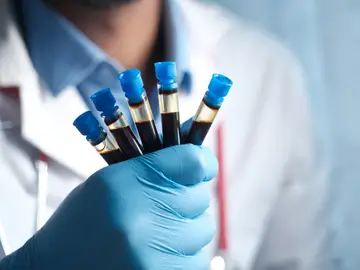 La prostasina, una proteína que puede predecir el riesgo de diabetes y de muerte por cáncer La prostasina, una proteína que puede predecir el riesgo de diabetes y de muerte por cáncer