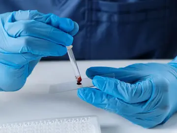 Se relaciona el riesgo de sufrir un ictus antes de los 60 años con el grupo sanguíneo Se relaciona el riesgo de sufrir un ictus antes de los 60 años con el grupo sanguíneo