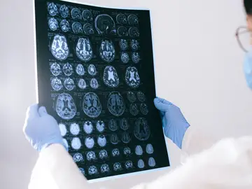Crean un biosensor que detecta tumores cerebrales con menos de una gota de sangre Crean un biosensor que detecta tumores cerebrales con menos de una gota de sangre