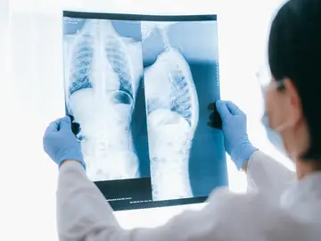 Logran que los tumores de pulmón resistentes a la inmunoterapia respondan al tratamiento Logran que los tumores de pulmón resistentes a la inmunoterapia respondan al tratamiento