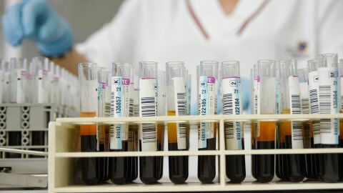 Un análisis de sangre rutinario permite diagnosticar Alzheimer en personas con síntomas tempranos