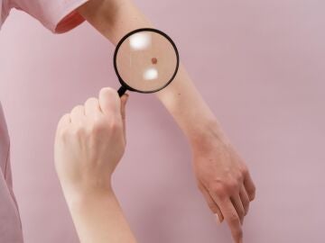 Investigadores españoles hallan el marcador para identificar si un cáncer de piel provocará metástasis 