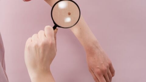 Investigadores españoles hallan el marcador para identificar si un cáncer de piel provocará metástasis 