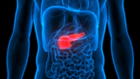 Cáncer de páncreas