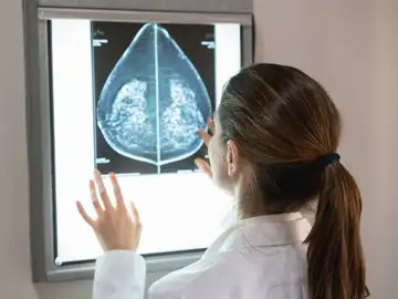 cáncer de mama, diagnóstico cáncer de mama, diagnóstico