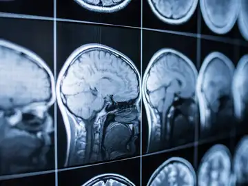 neuroimagen del cerebro neuroimagen del cerebro