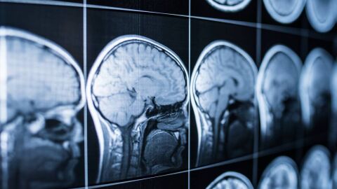 neuroimagen del cerebro