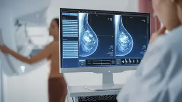 mamografía, cáncer de mama mamografía, cáncer de mama