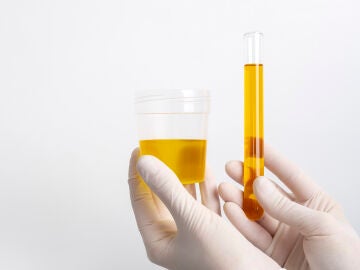 La orina, clave para detectar el cáncer de próstata en etapas tempranas gracias a la IA