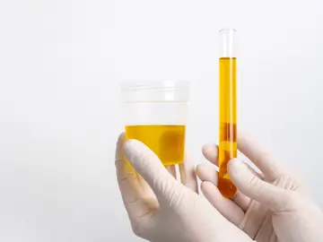 La orina, clave para detectar el cáncer de próstata en etapas tempranas gracias a la IA La orina, clave para detectar el cáncer de próstata en etapas tempranas gracias a la IA