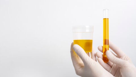 La orina, clave para detectar el cáncer de próstata en etapas tempranas gracias a la IA