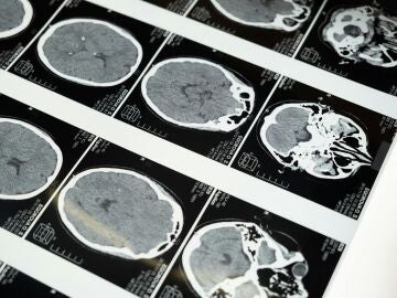 Identifican el momento en que se originan los tumores cerebrales más agresivos en niños