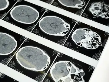 Identifican el momento en que se originan los tumores cerebrales más agresivos en niños Identifican el momento en que se originan los tumores cerebrales más agresivos en niños