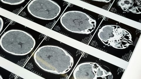 Identifican el momento en que se originan los tumores cerebrales más agresivos en niños