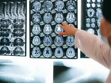 Utilizan la Inteligencia Artificial para identificar mutaciones clave vinculadas con enfermedades neurodegenerativas Utilizan la Inteligencia Artificial para identificar mutaciones clave vinculadas con enfermedades neurodegenerativas