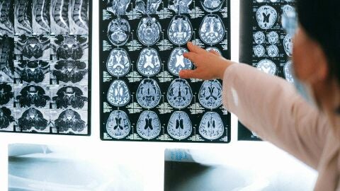 Utilizan la Inteligencia Artificial para identificar mutaciones clave vinculadas con enfermedades neurodegenerativas