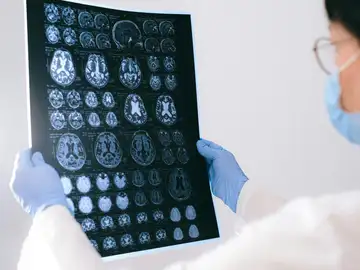 Una estimulación cerebral a medida frena la epilepsia resistente Una estimulación cerebral a medida frena la epilepsia resistente