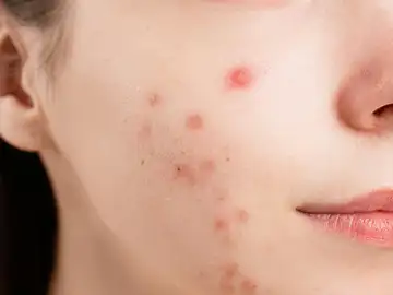 Varios dermatólogos aclaran los riesgos reales de manipular granos en el triángulo de la muerte Varios dermatólogos aclaran los riesgos reales de manipular granos en el triángulo de la muerte