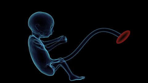 Los beneficios de la transfusión de sangre del cordón umbilical a prematuros extremos 