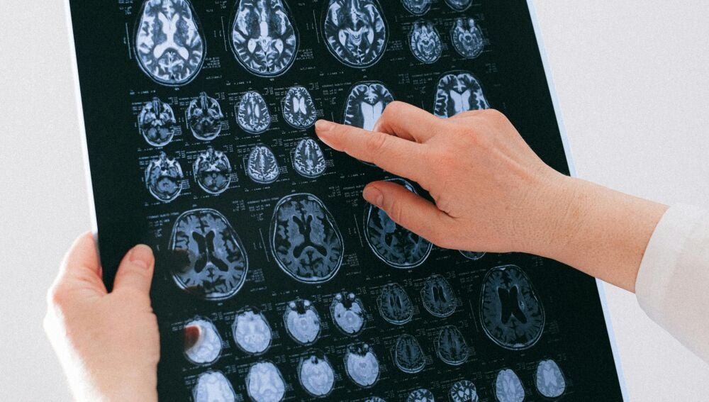 Un nuevo esc&aacute;ner cerebral detecta la prote&iacute;na tau del Alzheimer 