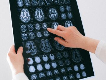 Un nuevo esc&aacute;ner cerebral detecta la prote&iacute;na tau del Alzheimer 